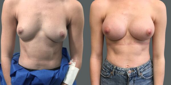 Breast Enlargement before and after in a grey background