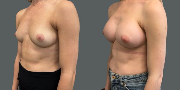 before and after a Breast Enlargement