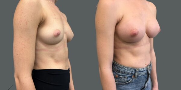 side by side a Breast Enlargement before and after in a grey background