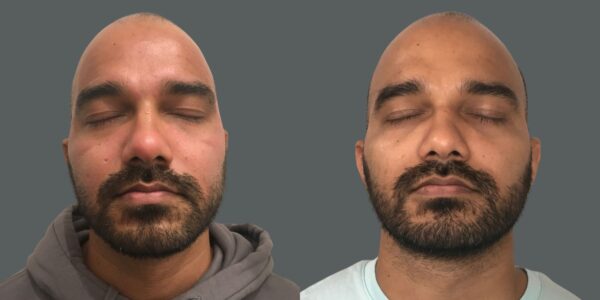 side by side before & after Dermapen treatment