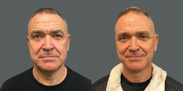 before and after deep plane facelift results