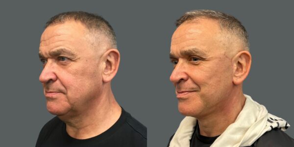 man's face before and after deep plane facelift results