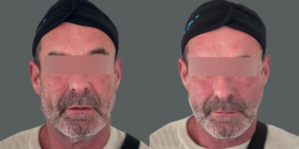 Before and after Mono Threads treatment for man’s face