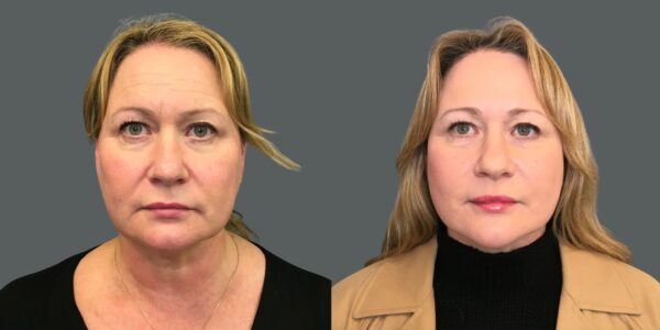 close-up of patient before and after facelift