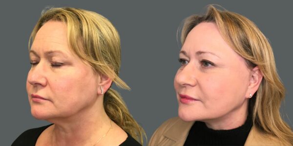 side close-up of patient before and after facelift